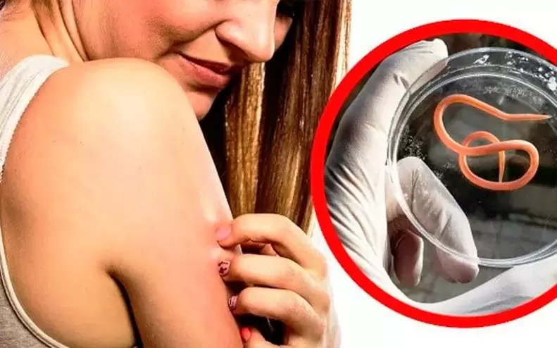 денедеги мите курттардан улам кычышуу жана кыжырдануу